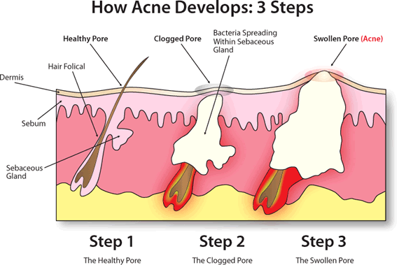 Is Acne affecting your life?